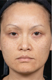 Patient # 69940 Before Photo # 1